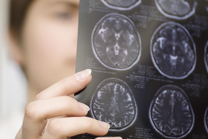 ‘Best news’ for Alzheimer’s drug trials in 25 years